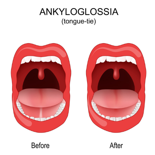 Tongue Tie Release - Dental Wire Dental Clinic