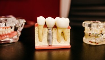 ROOT CANAL TREATMENT